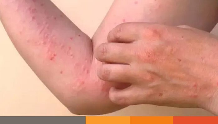 ফিরছে চিকুনগুনিয়া, বিশ্ব স্বাস্থ্য সংস্থার সতর্কতা